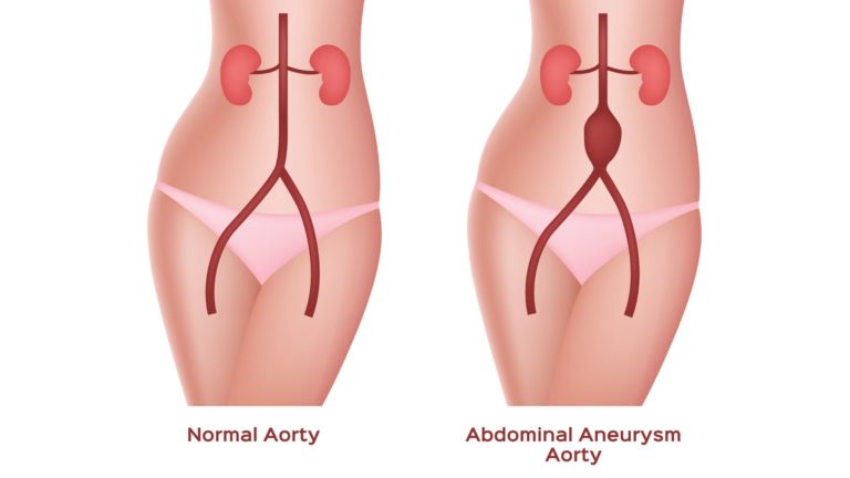 diagram of an abdominal aneurysm
