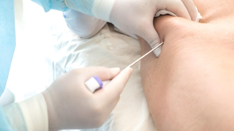 bone marrow transplant
