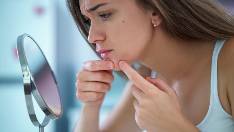 young girl dealing with acne for first time